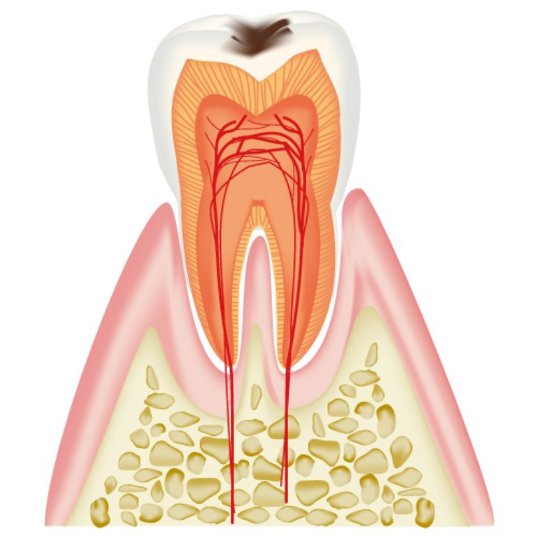 C1 エナメル質のむし歯