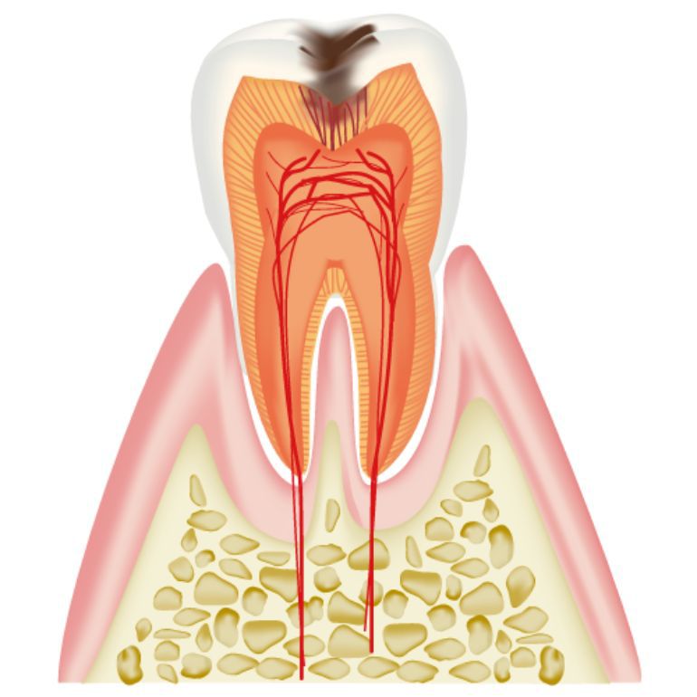 C2 象牙質のむし歯