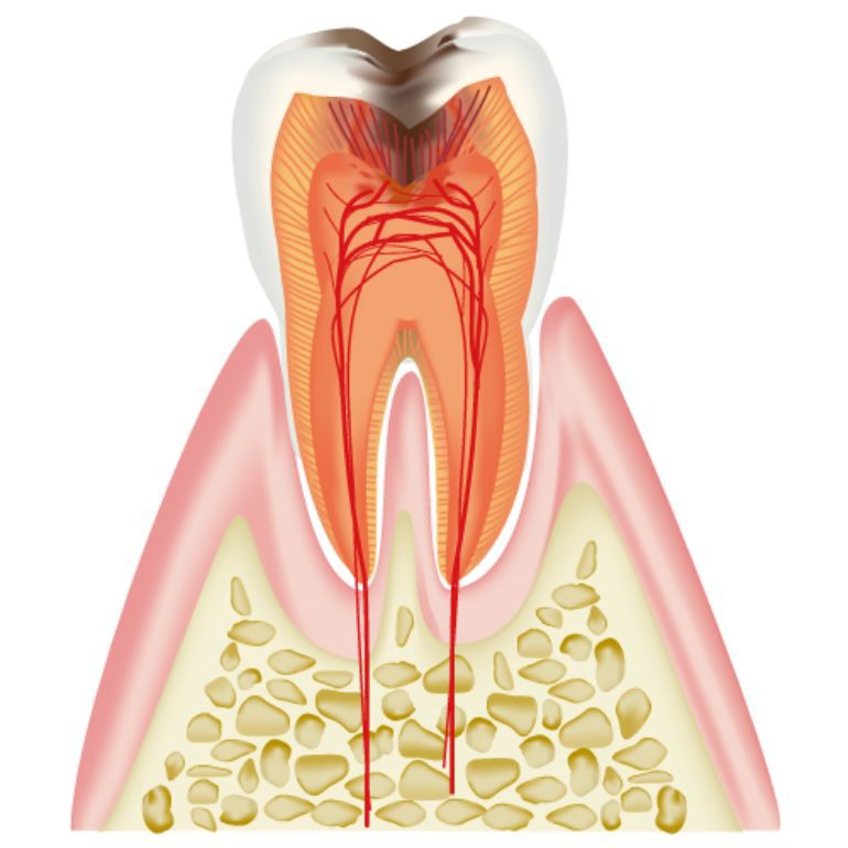 C3 神経まで達したむし歯