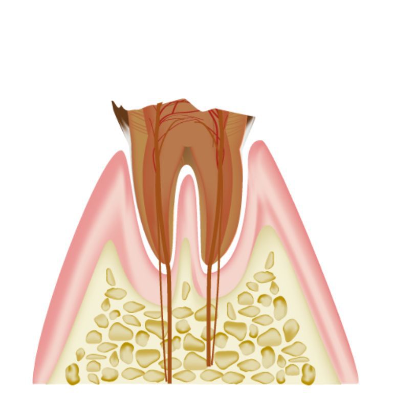 C4 歯根まで達したむし歯